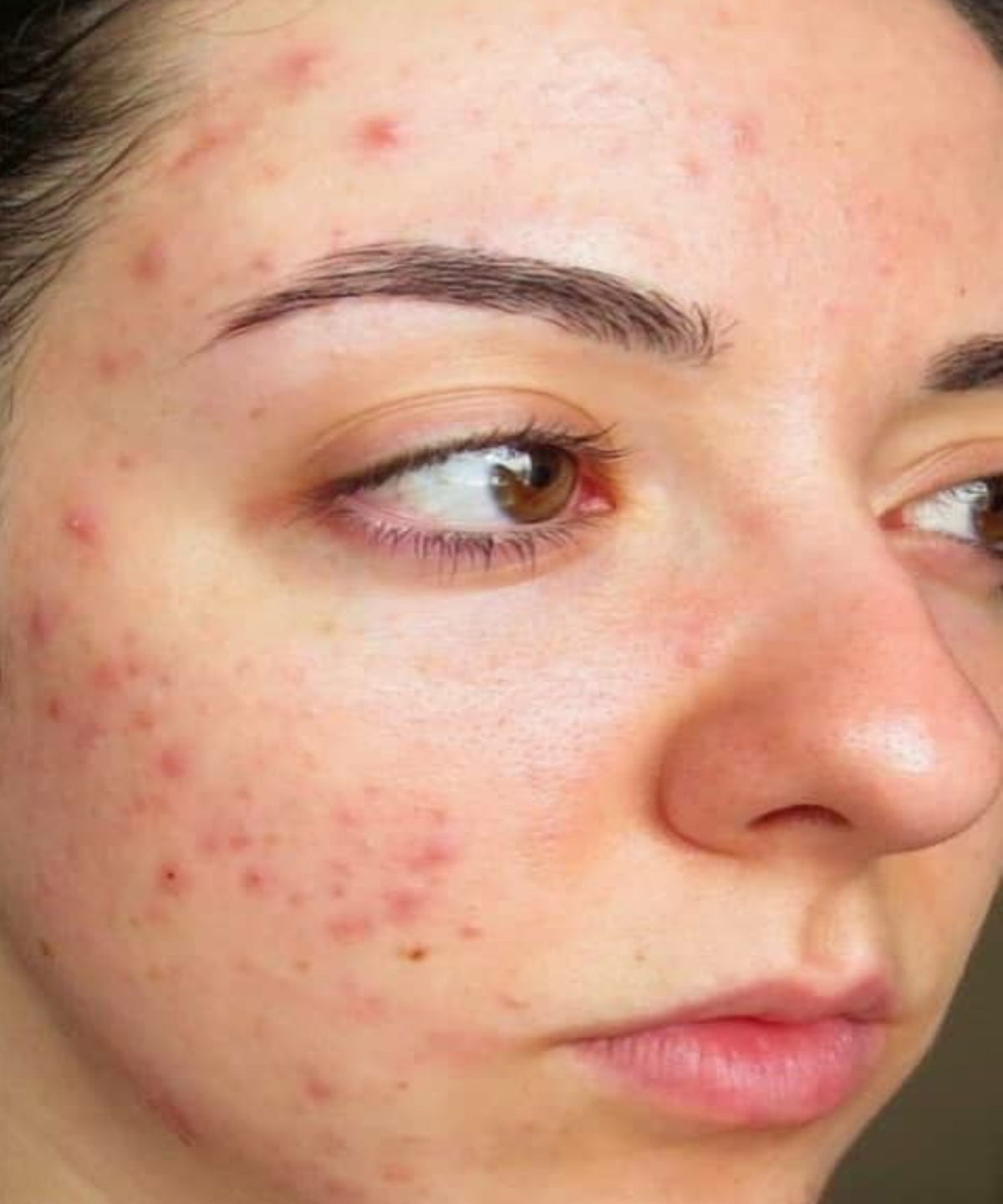 Hyper Pigmentation To Clear Skin