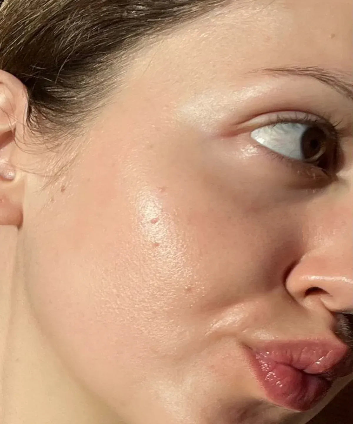 Acne To Anti-Acne
