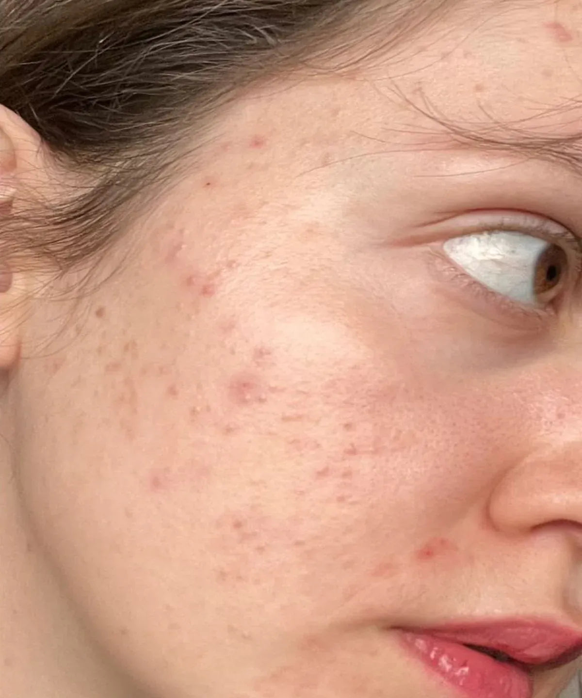Acne To Anti-Acne